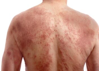 dermatita-atopica