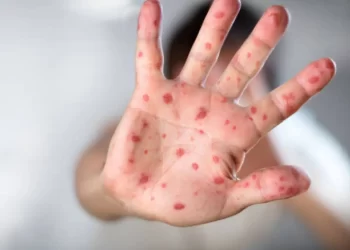 difteria
