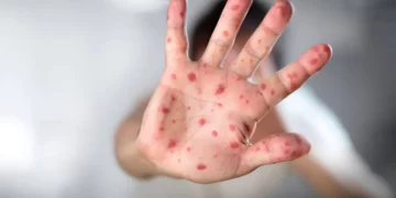 difteria