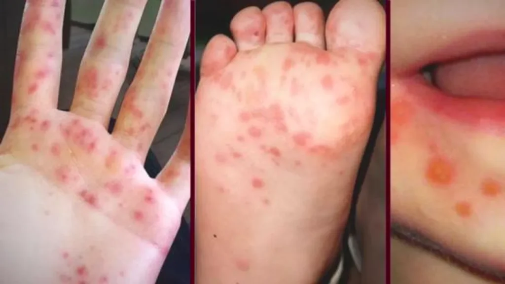 boala-contagioasa