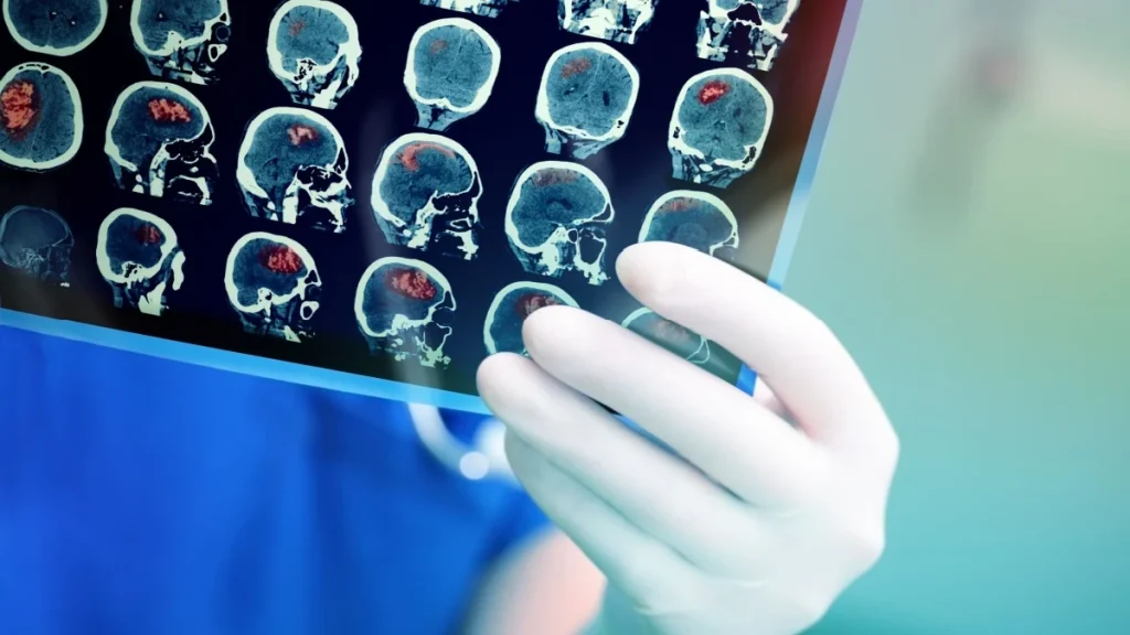 accident-vascular-cerebral