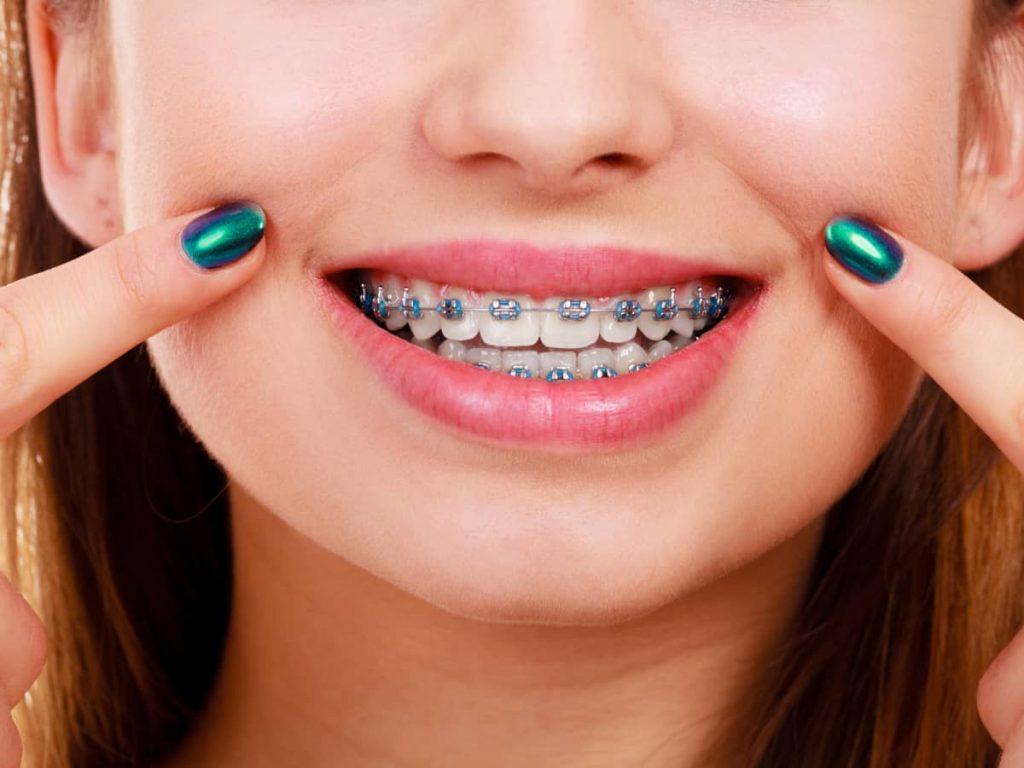 tanara-aparat-dentar